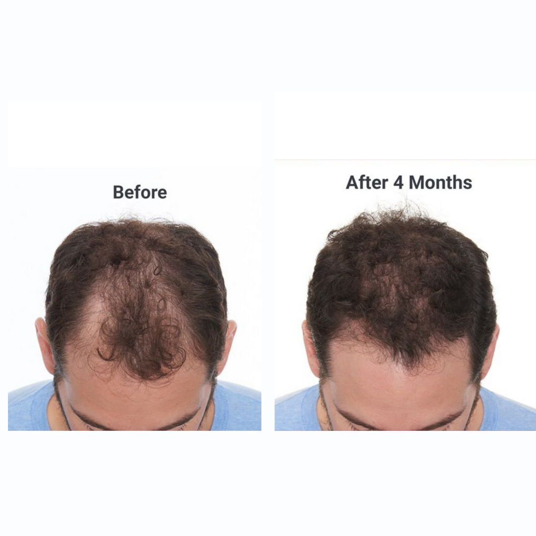 Amara Natural Hair Growth Oil - Backed by Science. Made for Men.